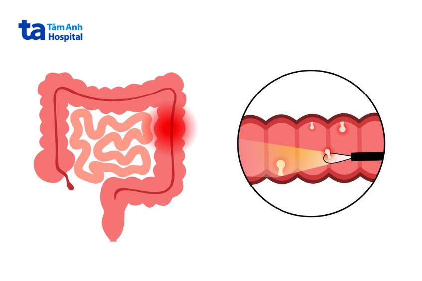 polyp đại tràng có thể loại bỏ