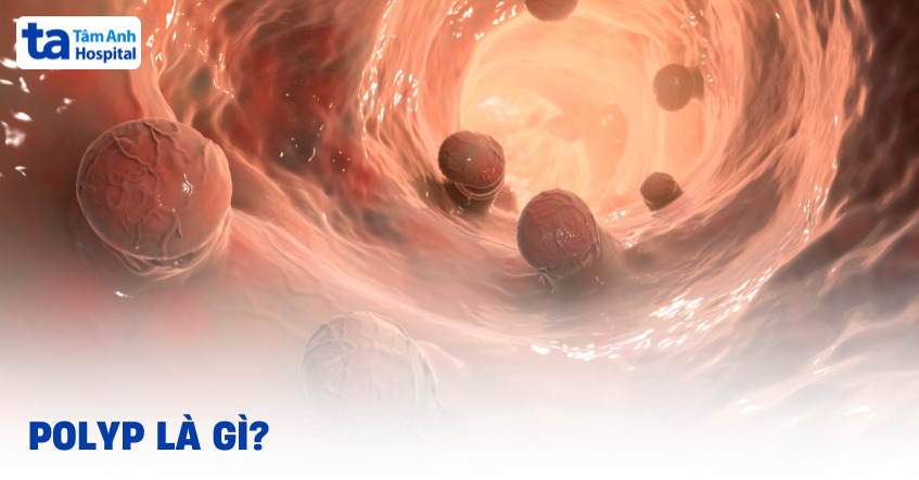 Polyp là gì? Có phải ung thư không?