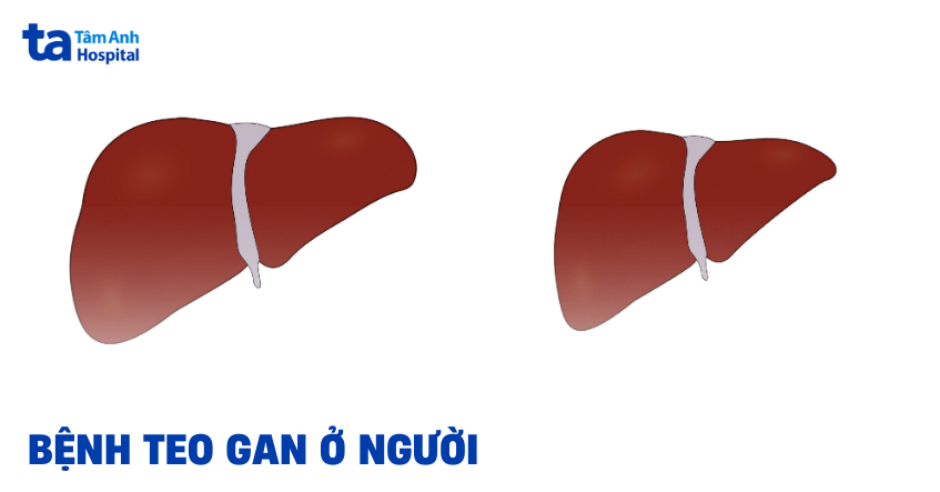 Phát hiện sớm teo gan ở người cần phải chú ý gì?