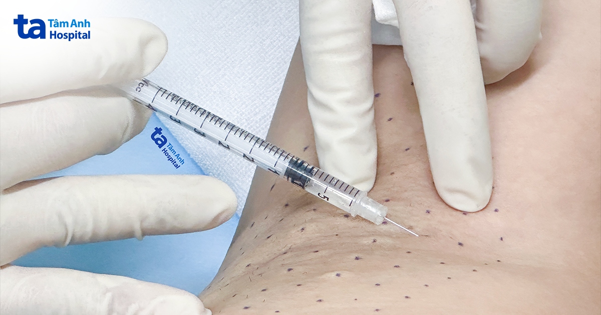 Tiêm botox trị mồ hôi nách cho phụ nữ sau sinh