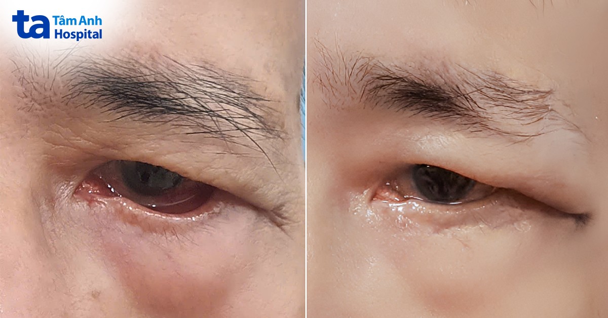 tình trạng mi mắt của bệnh nhân sau phẫu thuật