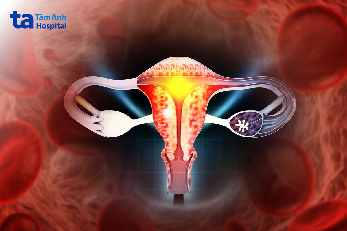 Minh họa tổn thương cổ tử cung liên quan HPV nguy cơ cao