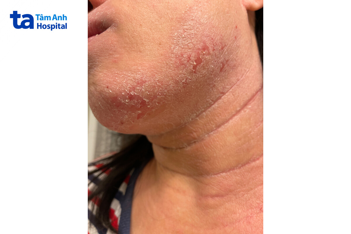 trường hợp da nhiễm corticoid nặng không được tự ý điều trị