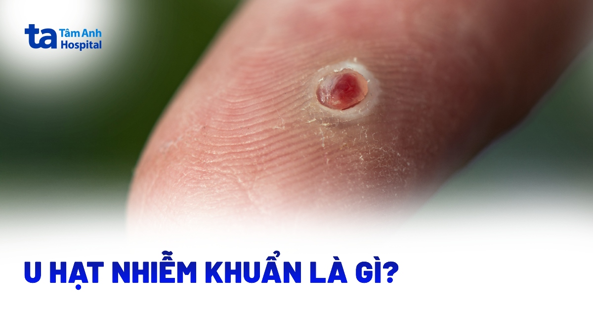 U hạt nhiễm khuẩn: Làm sao để nhận biết?