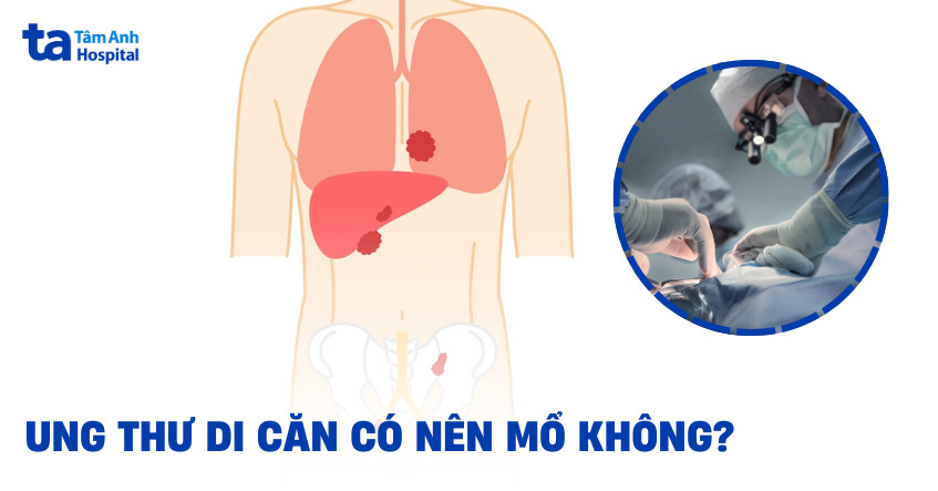 Ung thư di căn có nên mổ không?