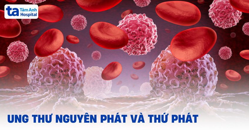 Cách phân biệt ung thư nguyên phát và thứ phát​