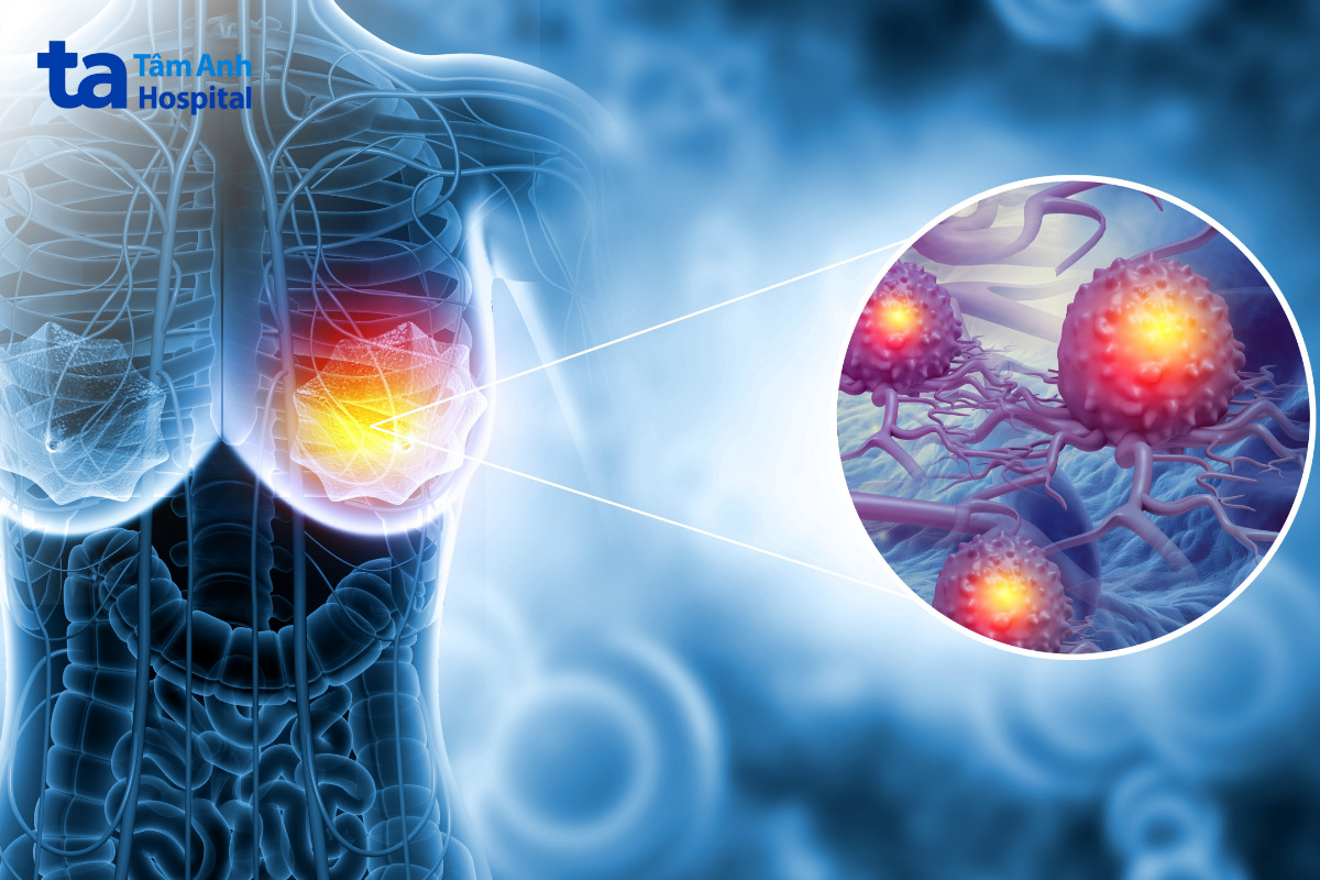 ung thư vú đáp ứng liệu pháp hormone