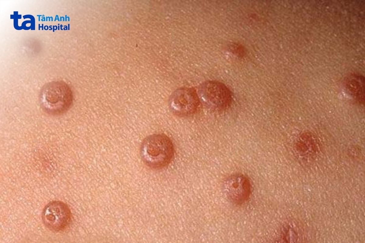 ưu nhược điểm phương pháp trị u mềm lây bằng ni tơ lỏng