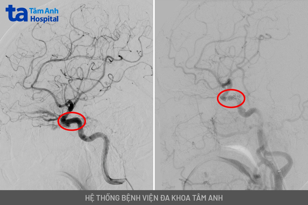 vị trí rò tĩnh mạch cứng xoang hang