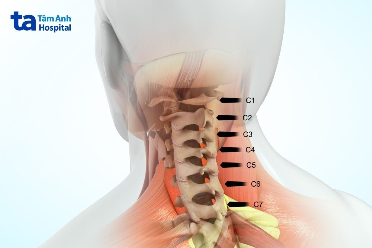 vị trí thường bị vôi hóa đốt sống cổ