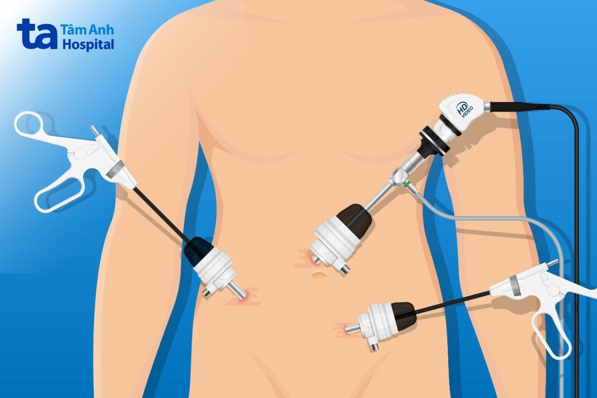 vị trí trocar mổ ruột thừa