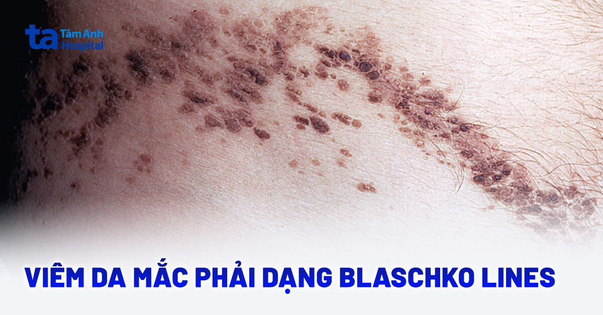 Tìm hiểu viêm da dạng đường Blaschko (BLAISE)