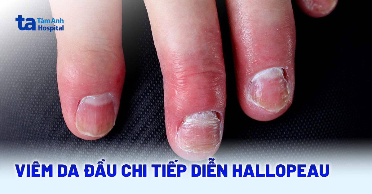Viêm da đầu chi liên tục: Bệnh hiếm gặp cần thận trọng