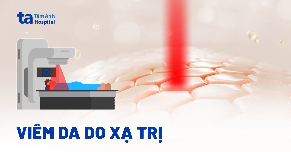 Viêm da do xạ trị xảy ra như thế nào?