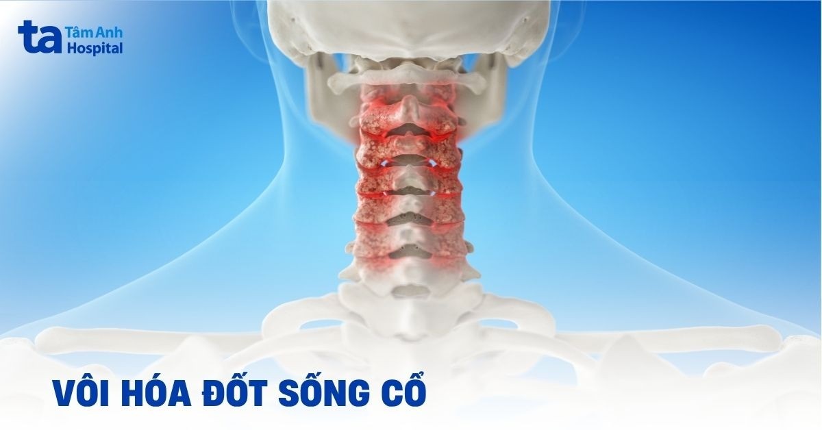 Hướng xử trí vôi hóa đốt sống cổ như thế nào?