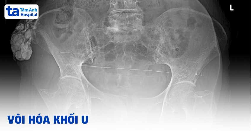 Tìm hiểu về tình trạng vôi hóa khối u
