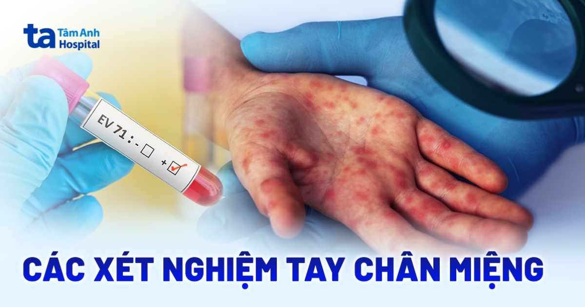 Các xét nghiệm tay chân miệng giúp chẩn đoán bệnh chính xác