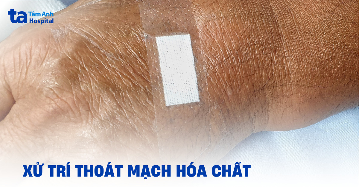 Xử trí thoát mạch hóa chất đúng cách trong điều trị ung thư