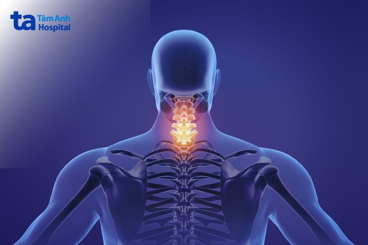 yếu tố gây vôi hóa đốt sống cổ