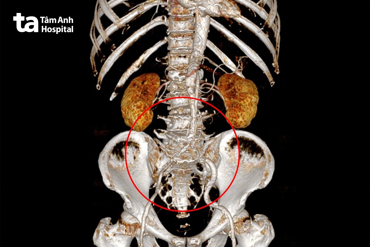 Ảnh chụp CT dựng hình 3D cho thấy người bệnh bị hẹp nghiêm trọng tại khu vực ngã ba động mạch chủ chậu