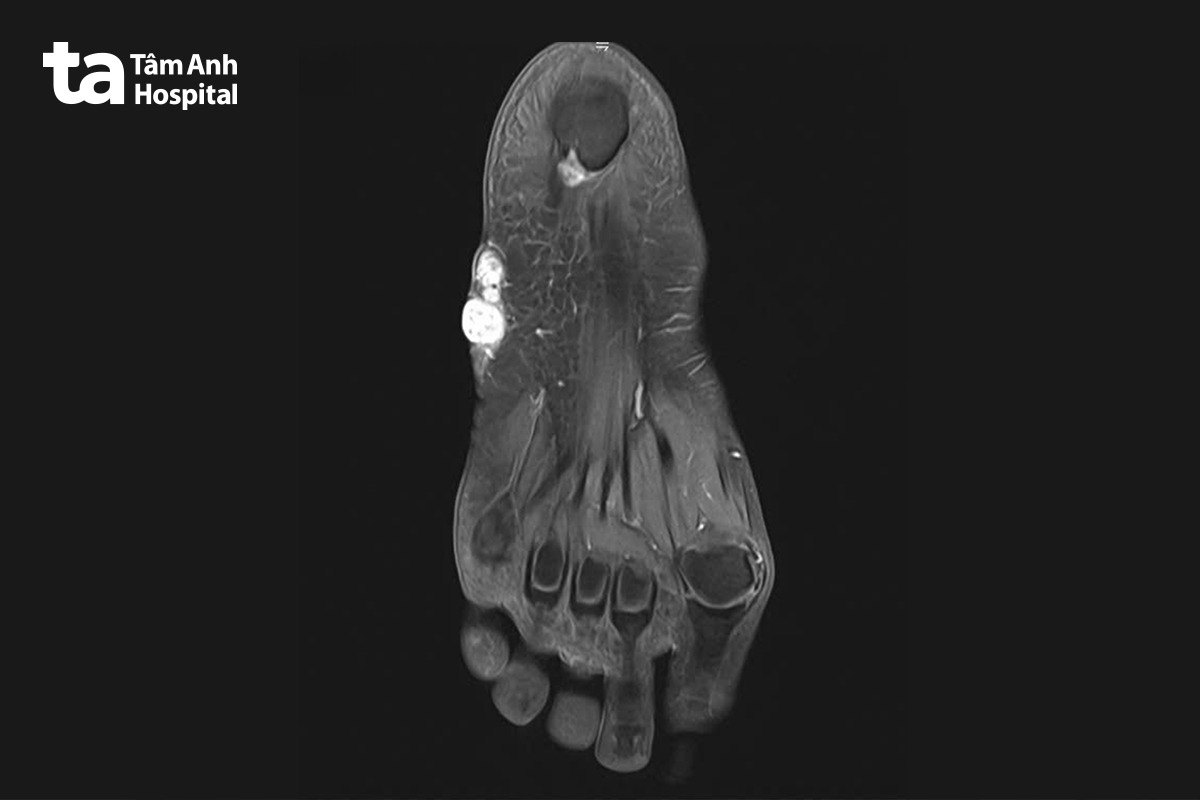 Ảnh chụp MRI cho thấy các bướu máu xuất hiện rải rác ở lòng bàn chân người bệnh