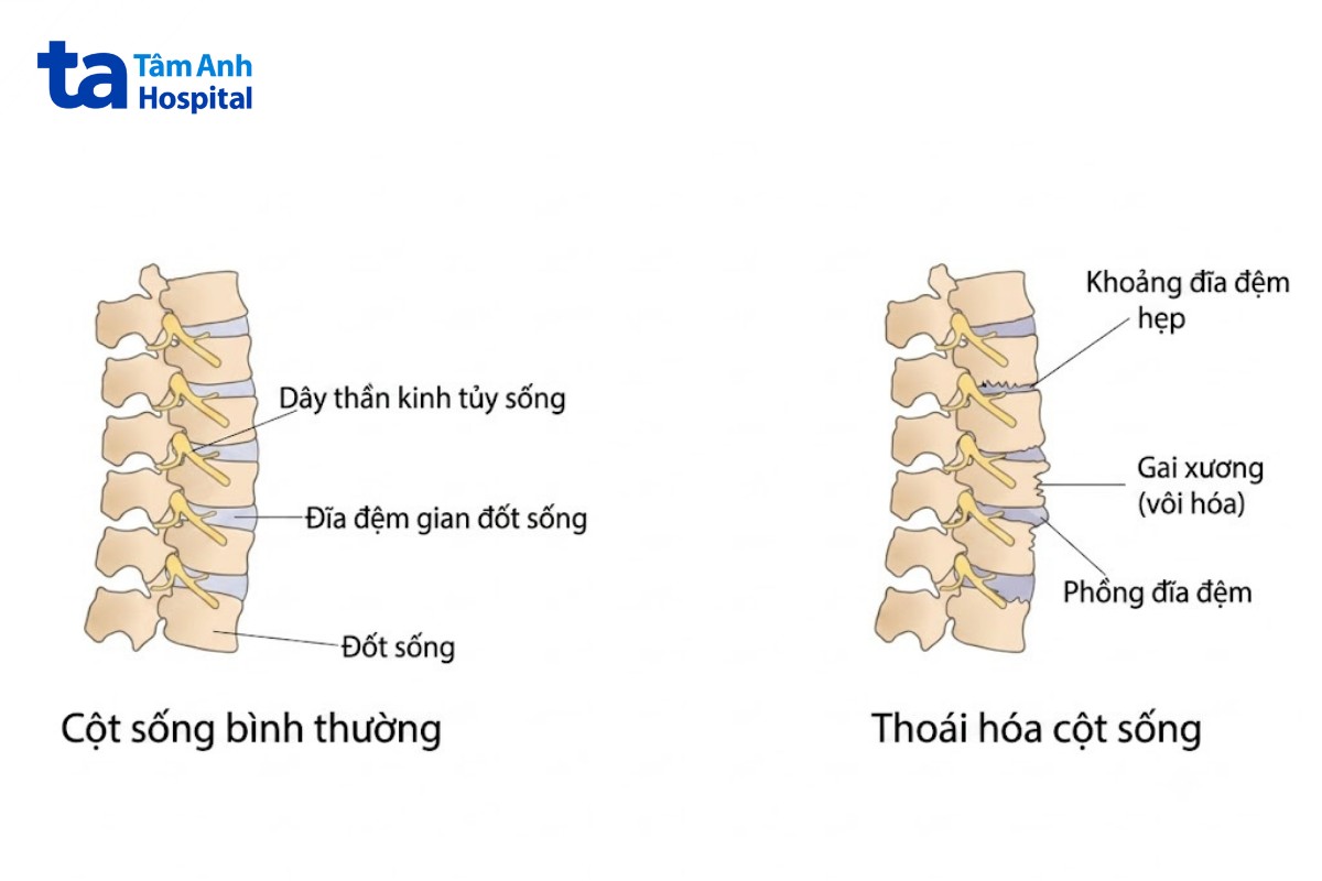Ảnh Thoái Hóa Cột Sống M47