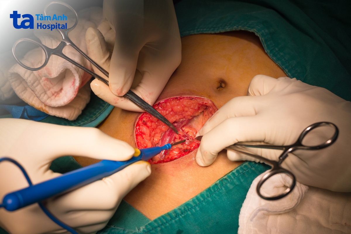 bác sĩ cắt ruột thừa