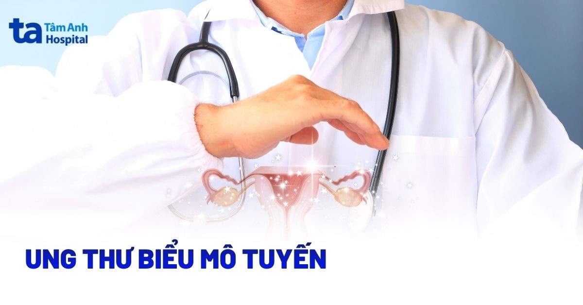 Ung thư biểu mô tuyến là gì? Những điều cần biết