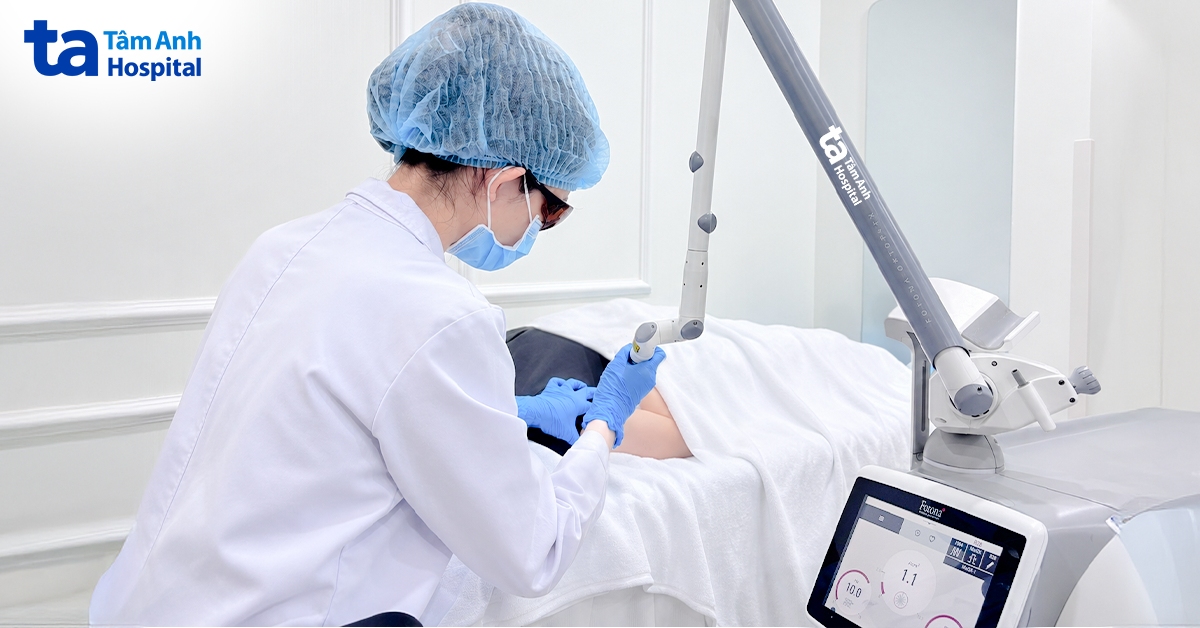 bác sĩ sử dụng laser pico xóa mực xăm cho chị ánh