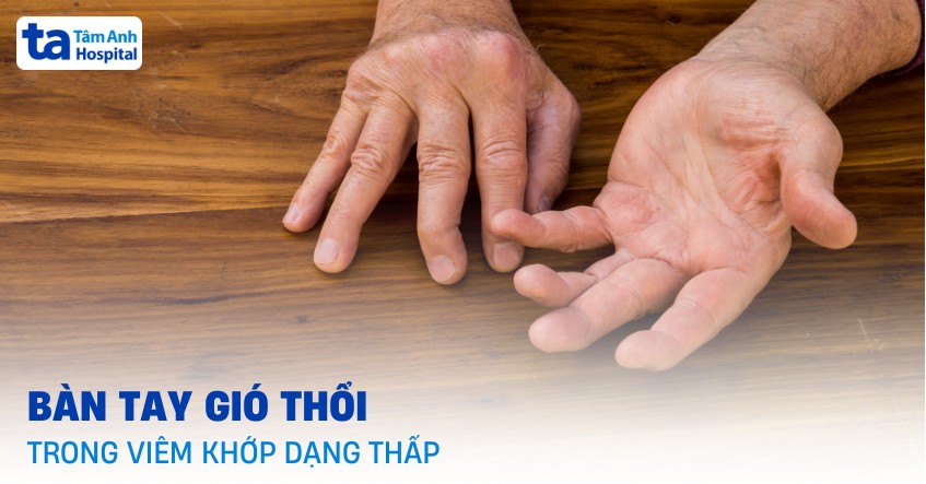 Tổng quan về bàn tay gió thổi trong viêm khớp dạng thấp