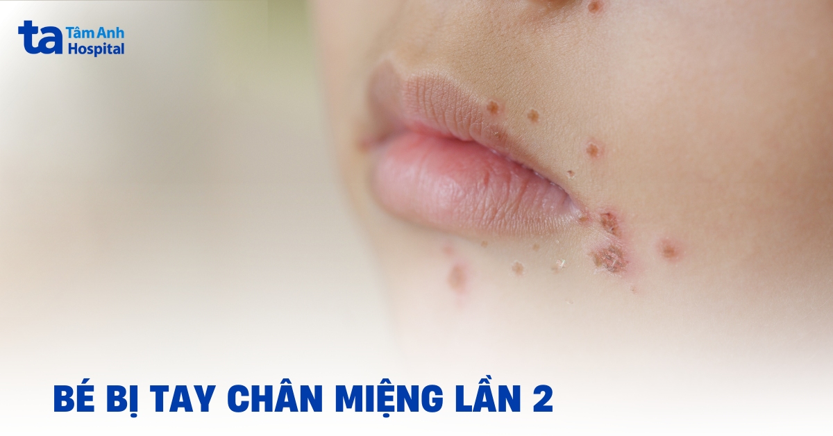 Bé bị tay chân miệng lần 2 do đâu?