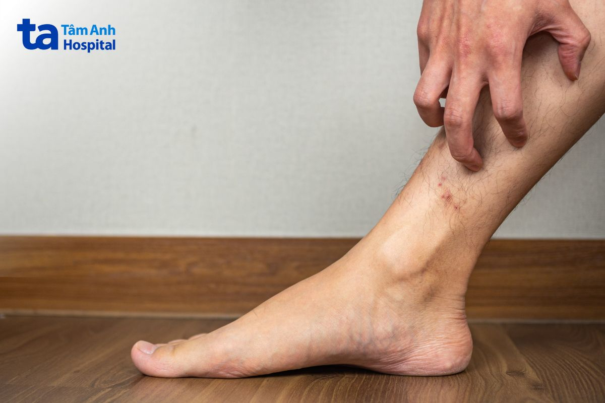bệnh da do đái tháo đường ở cẳng chân thường