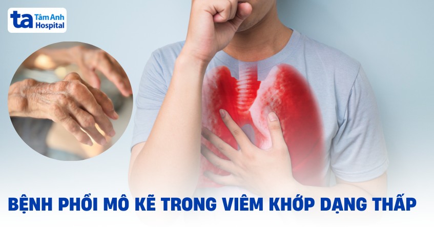 Tìm hiểu về bệnh phổi mô kẽ trong viêm khớp dạng thấp