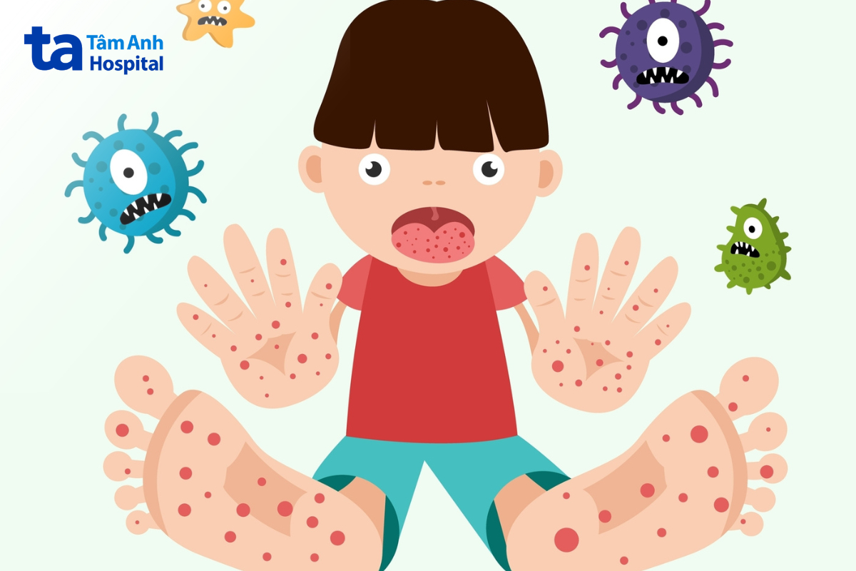 bệnh tay chân miệng ở trẻ có thể do nhiều chủng virus gây ra