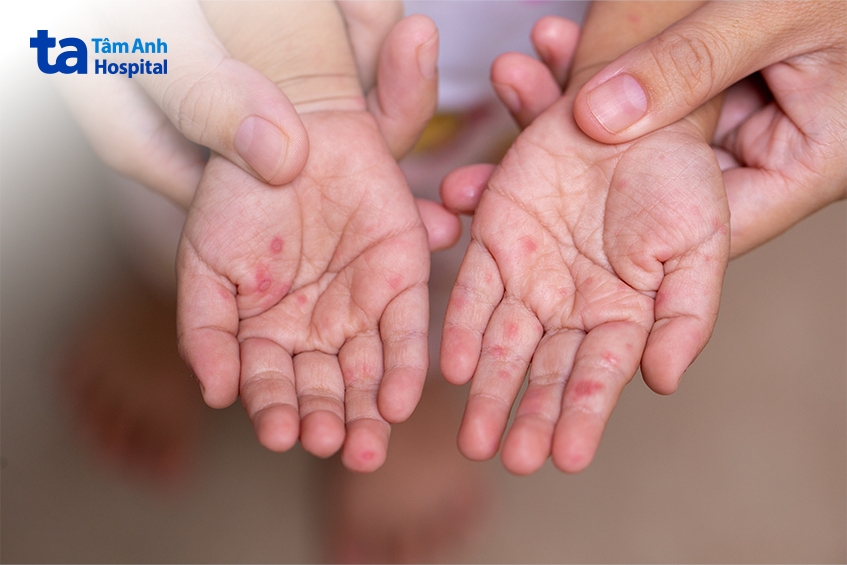 bệnh tay chân miệng tại việt nam chủ yếu xảy ra ở trẻ nhỏ