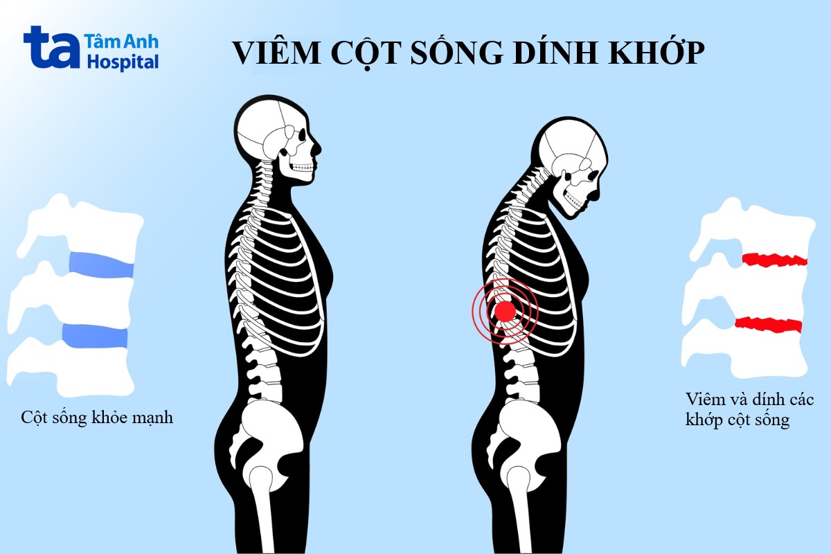 bị viêm cột sống dính khớp sống được bao lâu