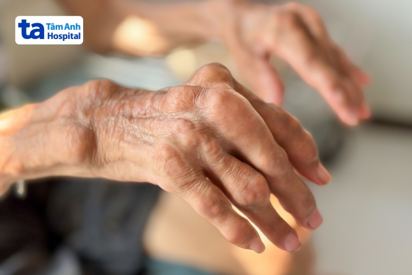 biến chứng phổi mô kẽ trong viêm khớp dạng thấp