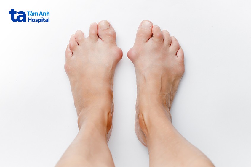 biến dạng khớp ngón chân cái