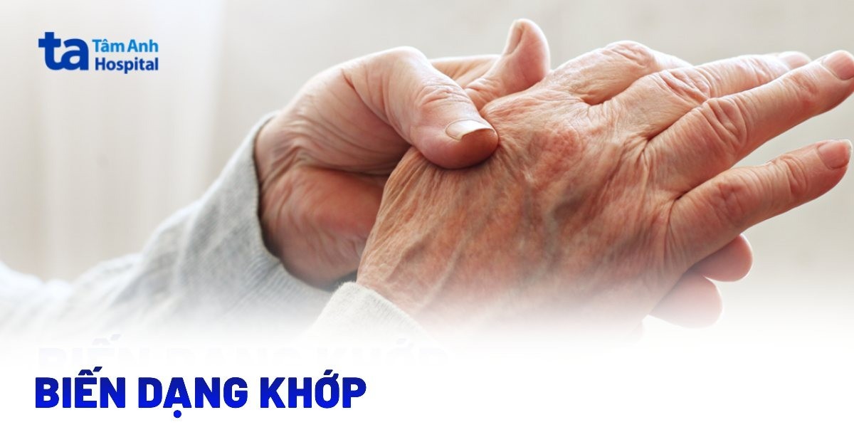 Biến dạng khớp: Nguyên nhân, triệu chứng, phòng ngừa và điều trị