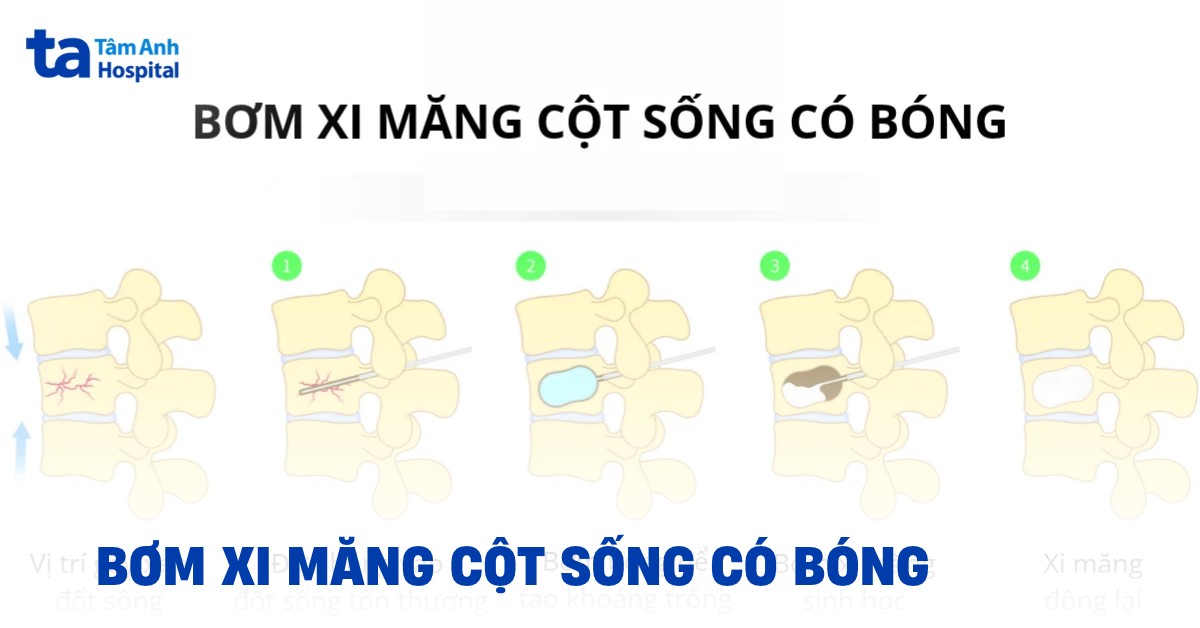 Bơm xi măng cột sống có bóng là gì? Có gì khác không bóng?