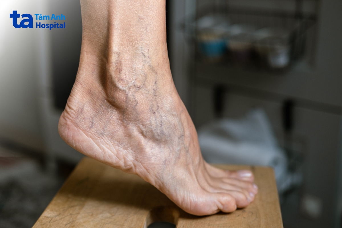 các bệnh lý tĩnh mạch