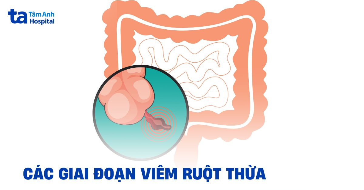 Các giai đoạn viêm ruột thừa: Diễn tiến bệnh