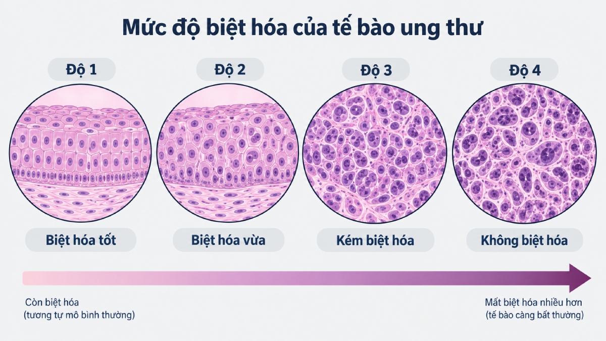 Minh họa 4 mức độ biệt hóa của khối u từ Grade 1 đến Grade 4