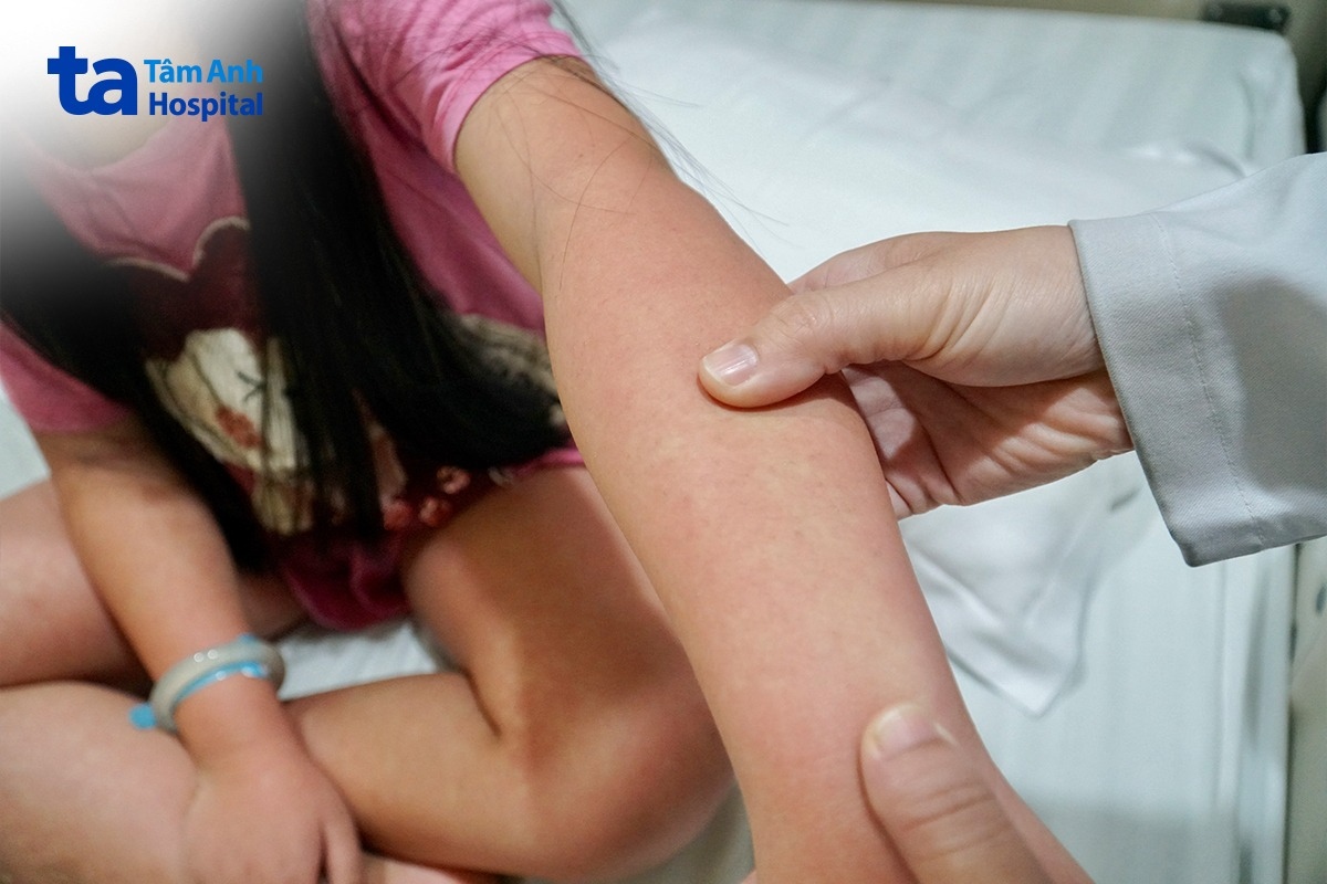 các nốt ban đỏ xuất hiện trên cánh tay bé