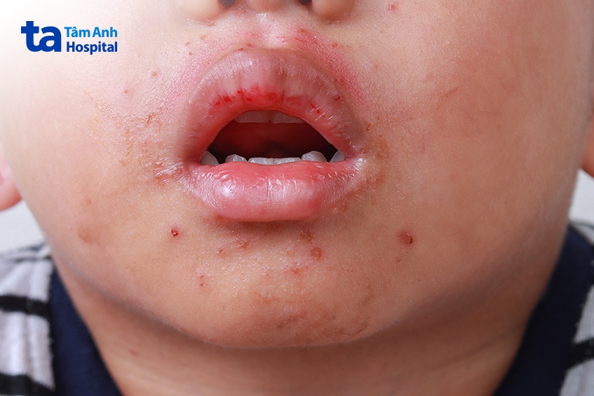 cách phân biệt nchân hiệt miệng và tay chân miệng