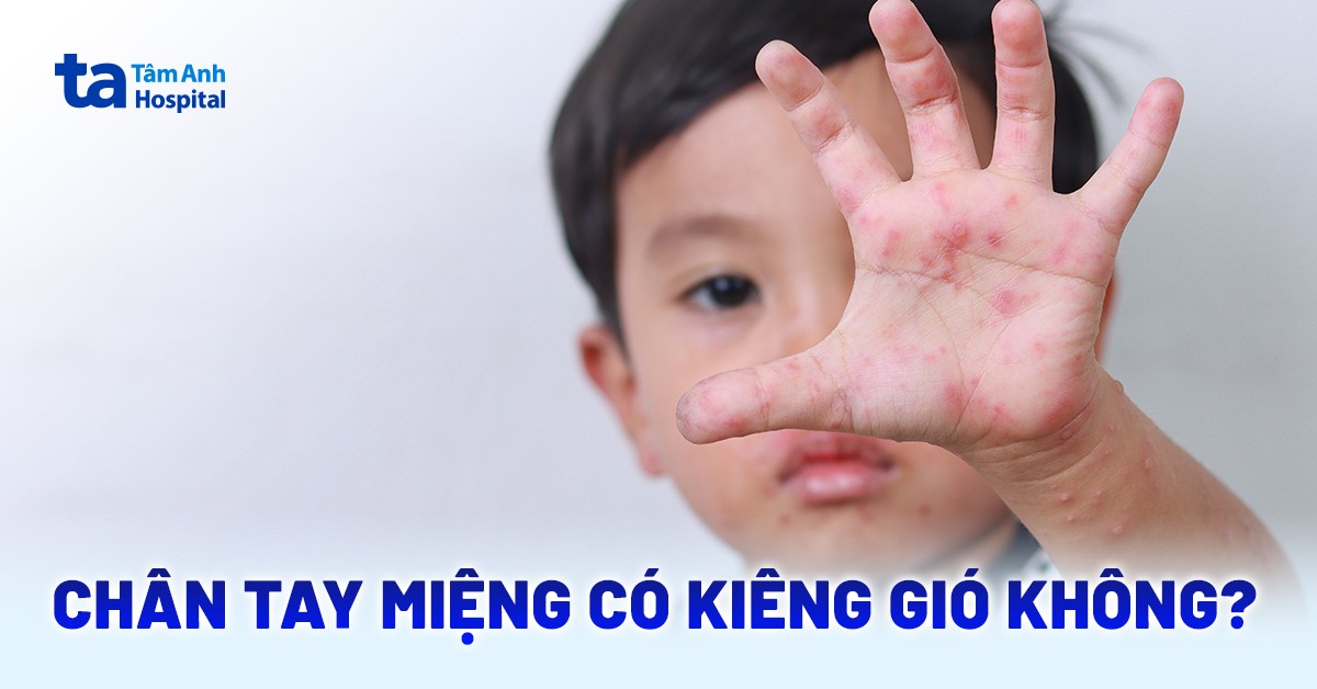 Trẻ nhỏ bị chân tay miệng có kiêng gió không?