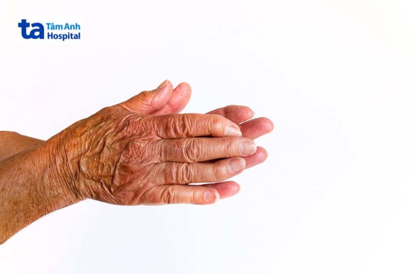 chỉ số cdai chẩn đoán viêm khớp dạng thấp