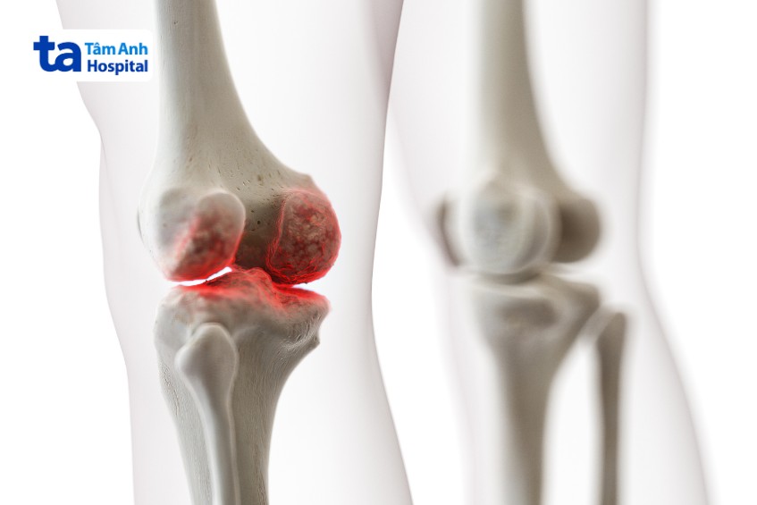 chống chỉ định điều trị viêm khớp dạng thấp bằng tế bào gốc