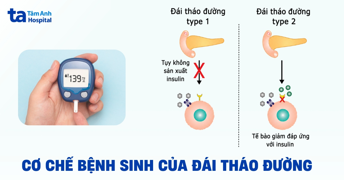 Cơ chế bệnh sinh đái tháo đường diễn ra như thế nào?