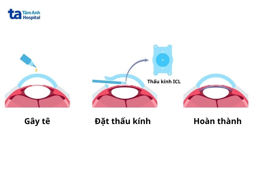 có nên mổ mắt lão thị